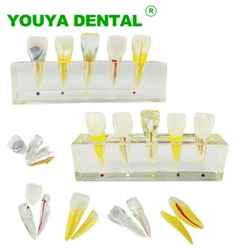 Zubné Model Endodontic Patologické Model Stomatológia Bielenie Buničiny Liečba Model Pre Zubný Lekár Klinického Pacienta Komunikácie